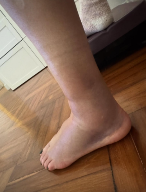 香港女星意外骨裂,脚肿得老高,曾和周润发闪婚又闪离插图1 香港女星意外骨裂,脚肿得老高,曾和周润发闪婚又闪离插图1